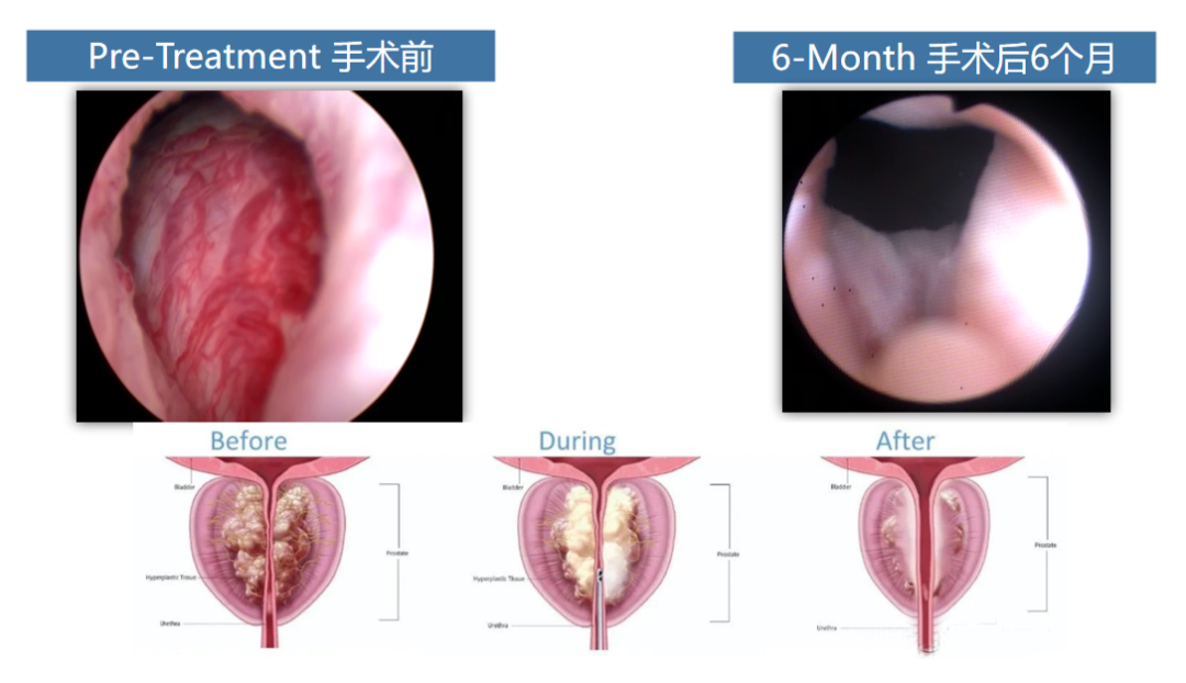 四川瑞梦热蒸汽消融术：前列腺增生治疗新技术！(图1)