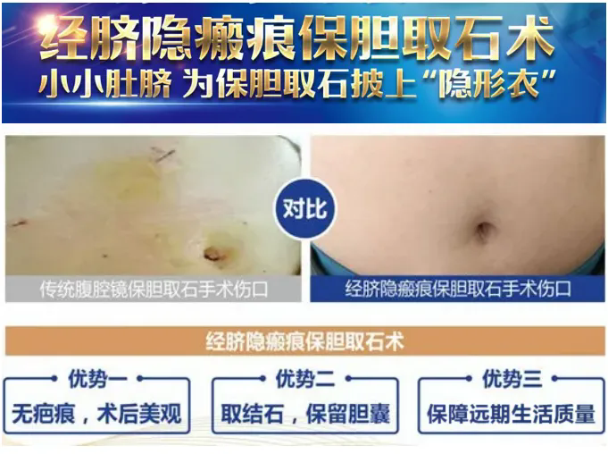 胆结石无症状期，保胆有哪些好处？何明刚主任为你全面详解【四川胆结石专科医院】(图4)