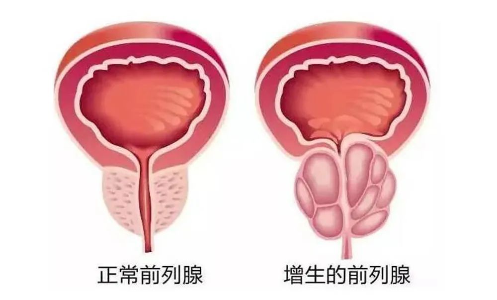 前列腺增生硬扛不得！危害比你想的更严重，科学应对是良策(图3)