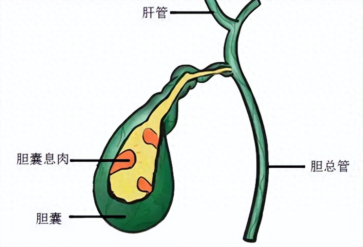 胆囊息肉究竟是良性还是恶性？哪些情况需要手术？一文说清【成都治疗胆囊息肉的医院】(图2)