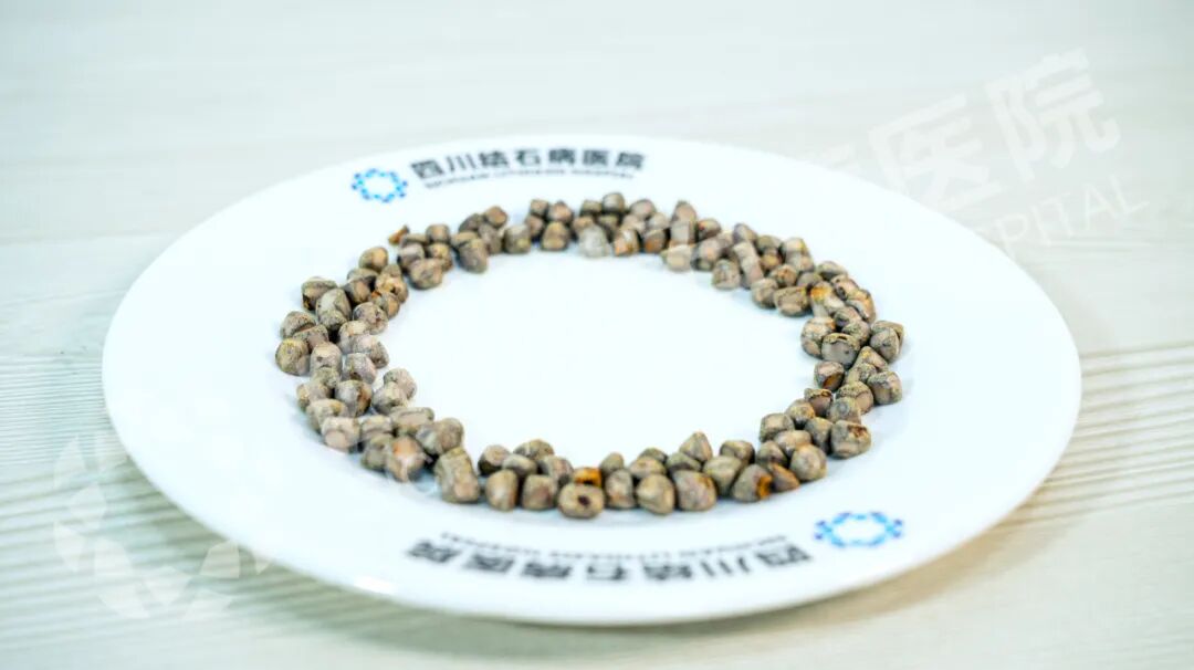 四川保胆案例分享：七年无感却藏126颗结石！男子胆囊惊现“珍珠串”(图1)