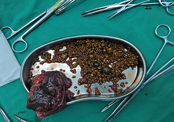 都江堰患者胆囊惊现1343颗结石 拖延治疗致胆囊坏疽【四川胆结石专科医院】(图4) 都江堰患者胆囊惊现1343颗结石 拖延治疗致胆囊坏疽【四川胆结石专科医院】(图4)