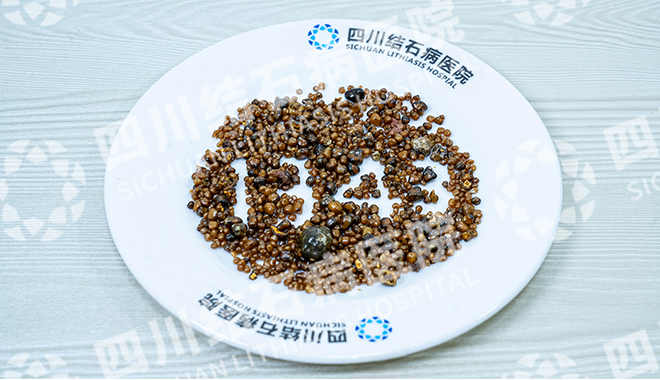 五天三例!四川结石病医院接连取出126颗、275颗、1343颗结石(图3) 五天三例!四川结石病医院接连取出126颗、275颗、1343颗结石(图3)