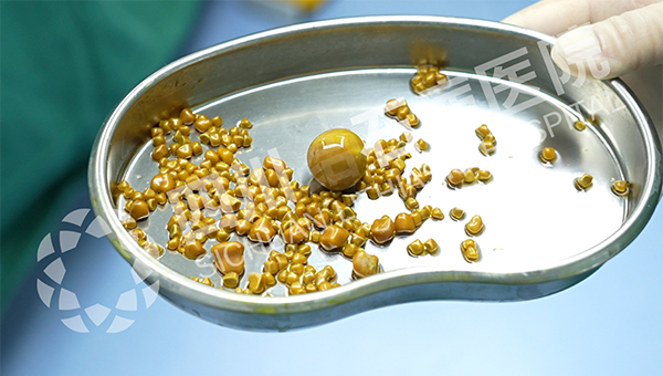 无症状≠无风险!40岁女子突发腹痛,四川结石病医院保胆取出275颗结石(图2) 无症状≠无风险!40岁女子突发腹痛,四川结石病医院保胆取出275颗结石(图2)