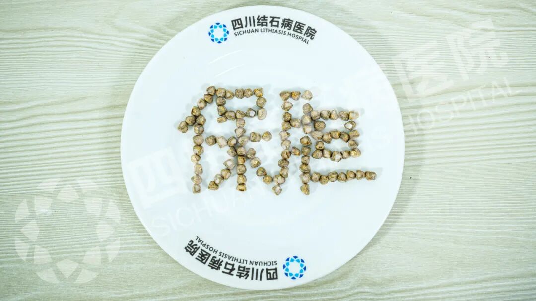126颗结石藏胆囊!杭州男子赴川保胆手术登热搜,这些风险别忽视(图6) 126颗结石藏胆囊!杭州男子赴川保胆手术登热搜,这些风险别忽视(图6)
