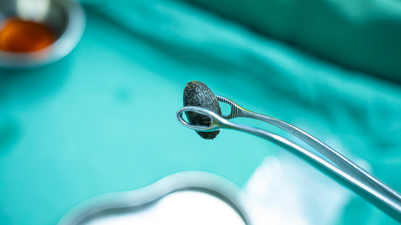 为“保胆”而来:北京国之名医刘京山教授再度来院,亲诊手术惠泽西南患者(图6) 为“保胆”而来:北京国之名医刘京山教授再度来院,亲诊手术惠泽西南患者(图6)