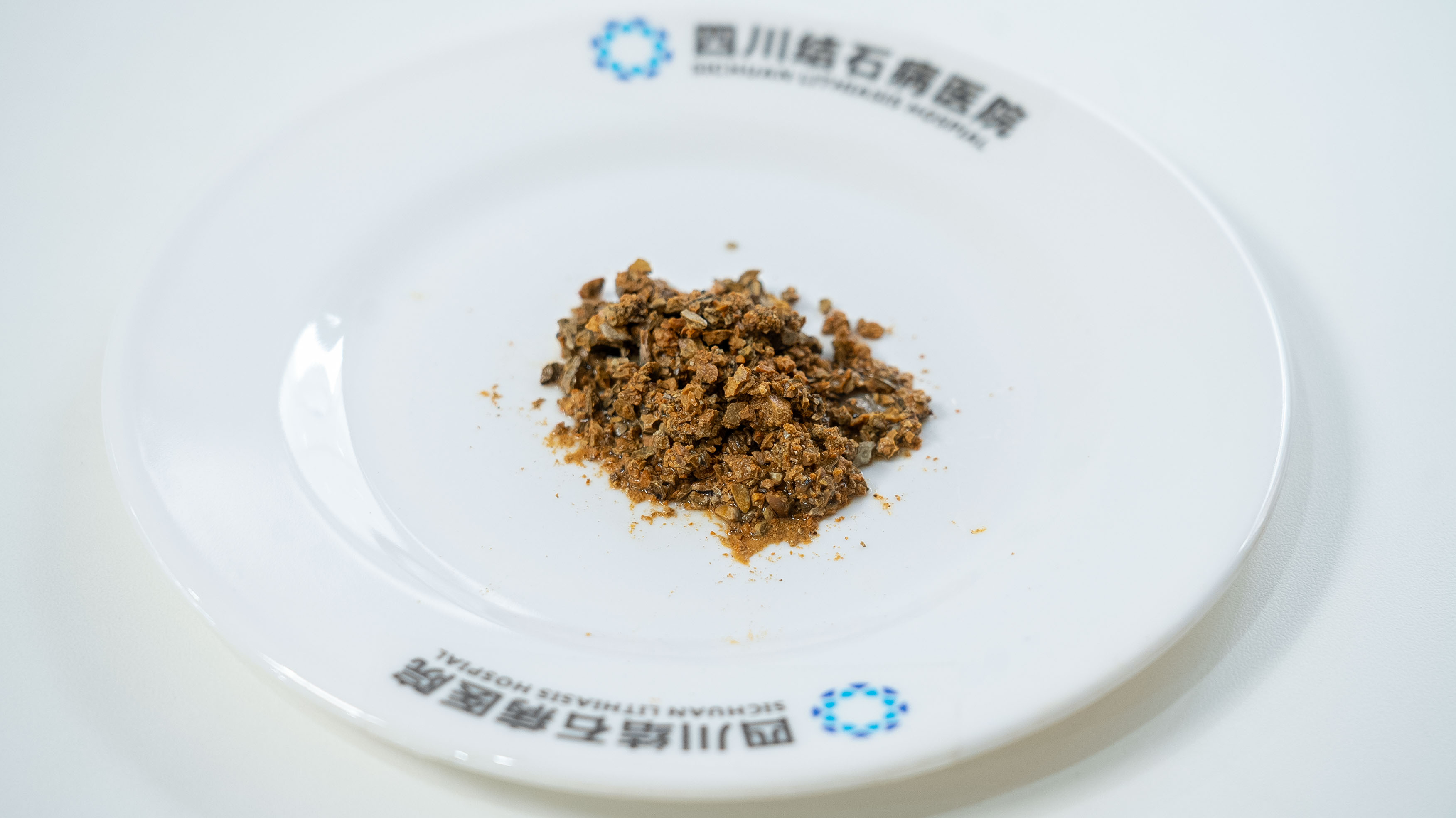 胆结石患者注意!这3个关键时机一错过,胆囊可能就保不住了【四川胆结石专科医院】(图3) 胆结石患者注意!这3个关键时机一错过,胆囊可能就保不住了【四川胆结石专科医院】(图3)