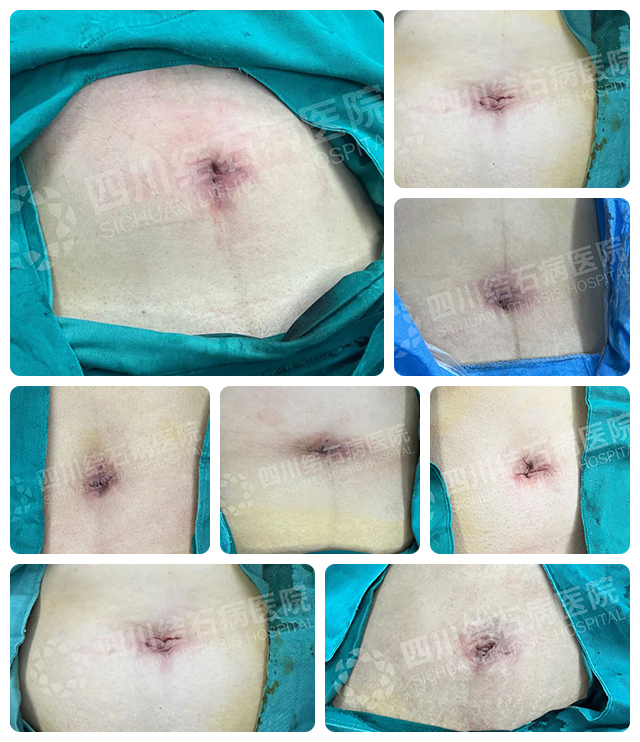 胆结石的3个黄金干预期,很多人都错过了!别等切胆囊才后悔【四川胆结石专科医院】(图5) 胆结石的3个黄金干预期,很多人都错过了!别等切胆囊才后悔【四川胆结石专科医院】(图5)