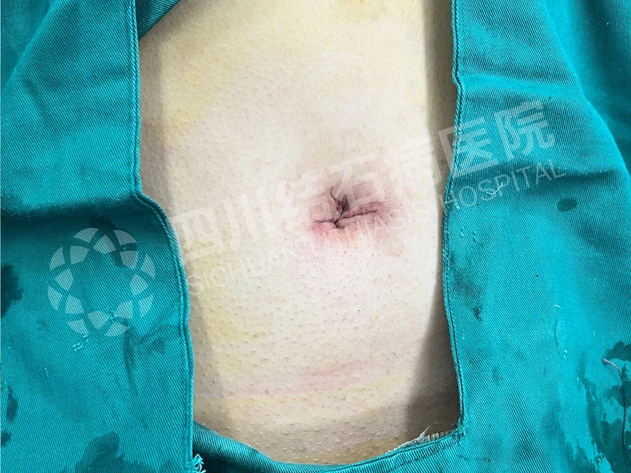 怕留疤?怕切胆?经脐隐瘢痕技术实现“鱼与熊掌兼得”【四川结石病医院】(图4) 怕留疤?怕切胆?经脐隐瘢痕技术实现“鱼与熊掌兼得”【四川结石病医院】(图4)
