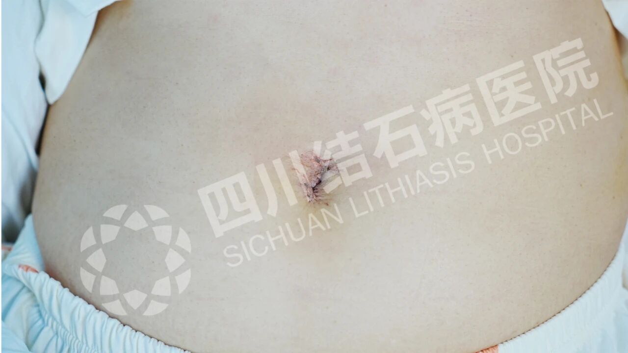 怕留疤?怕切胆?经脐隐瘢痕技术实现“鱼与熊掌兼得”【四川结石病医院】(图5) 怕留疤?怕切胆?经脐隐瘢痕技术实现“鱼与熊掌兼得”【四川结石病医院】(图5)
