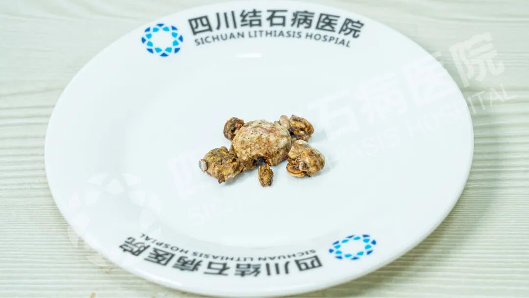 生死时速!胆结石发作保守治疗后,女子竟险遭生命危险!【四川结石病医院】(图5) 生死时速!胆结石发作保守治疗后,女子竟险遭生命危险!【四川结石病医院】(图5)