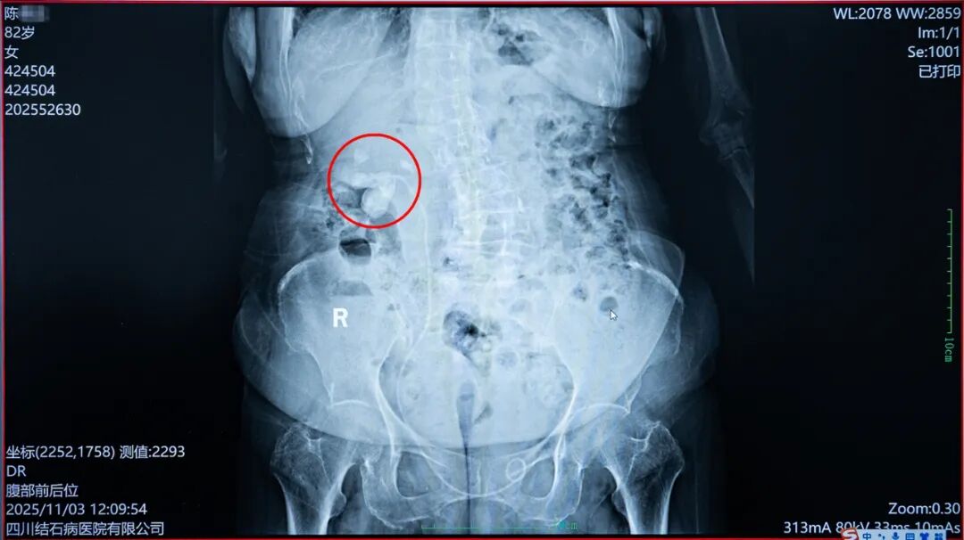 八旬奶奶“除石”记:当右肾铸型结石遇上医者仁心【四川结石病医院】(图4) 八旬奶奶“除石”记:当右肾铸型结石遇上医者仁心【四川结石病医院】(图4)
