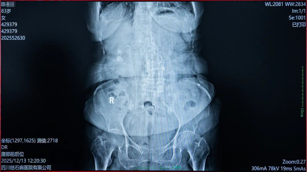 八旬奶奶“除石”记:当右肾铸型结石遇上医者仁心【四川结石病医院】(图5) 八旬奶奶“除石”记:当右肾铸型结石遇上医者仁心【四川结石病医院】(图5)