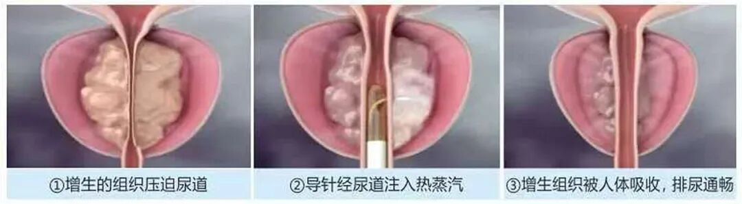 跨越3000公里的信任:新疆老人来蓉求医为“瑞梦”【四川瑞梦热蒸汽医院】(图6) 跨越3000公里的信任:新疆老人来蓉求医为“瑞梦”【四川瑞梦热蒸汽医院】(图6)