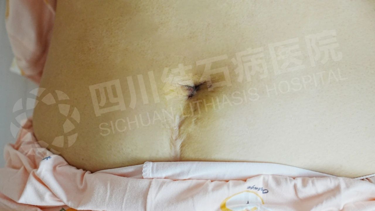 保胆又隐痕!经脐技术让患者直呼:这简直是胆结石患者的福音(图2) 保胆又隐痕!经脐技术让患者直呼:这简直是胆结石患者的福音(图2)