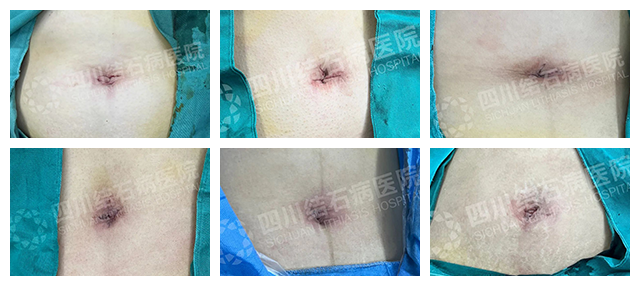 保胆又隐痕!经脐技术让患者直呼:这简直是胆结石患者的福音(图3) 保胆又隐痕!经脐技术让患者直呼:这简直是胆结石患者的福音(图3)