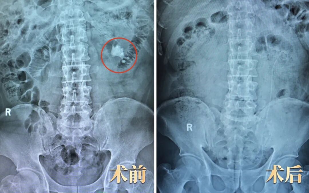 春节结石终结战：“软镜+VADL”组合拳取出12年顽石(图1)
