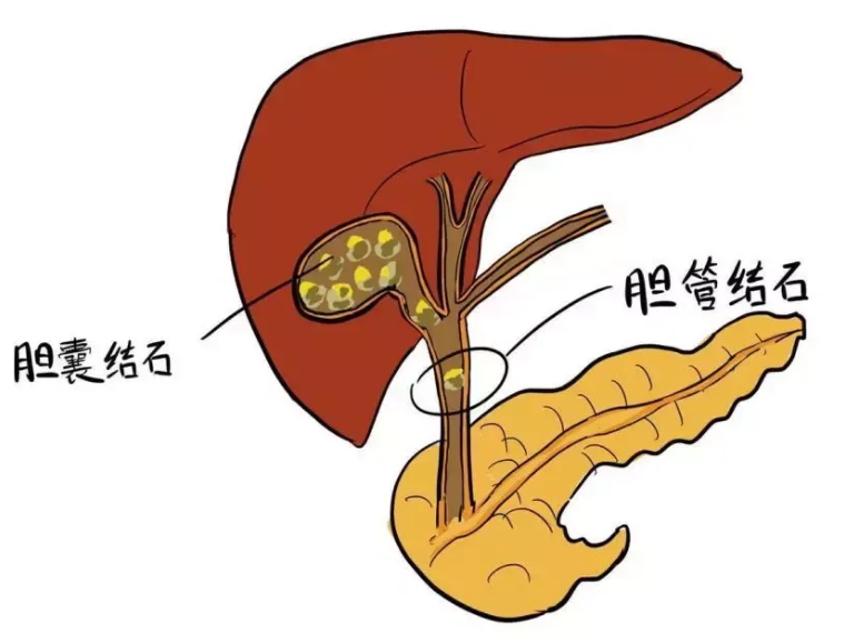 警惕胆结石：春节饮食放纵后，健康需及时 “补救”【四川结石病医院】(图2)
