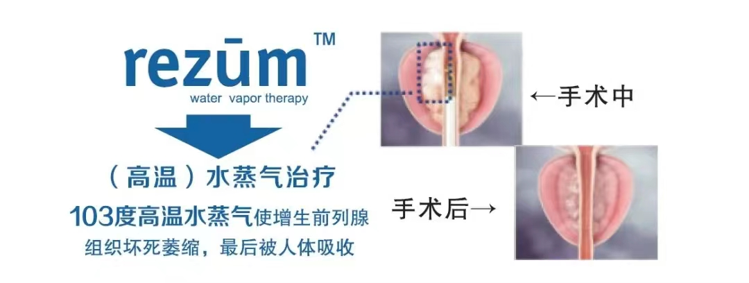 瑞梦热蒸汽消融术：破解前列腺增生困局，守护中老年男性健康！【四川瑞梦前列腺医院】(图3)