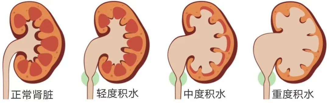 结石别乱碎！不当碎石易伤肾，这些误区务必避开｜成都体外碎石医院(图2)