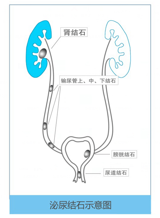 结石别乱碎！不当碎石易伤肾，这些误区务必避开｜成都体外碎石医院(图3)