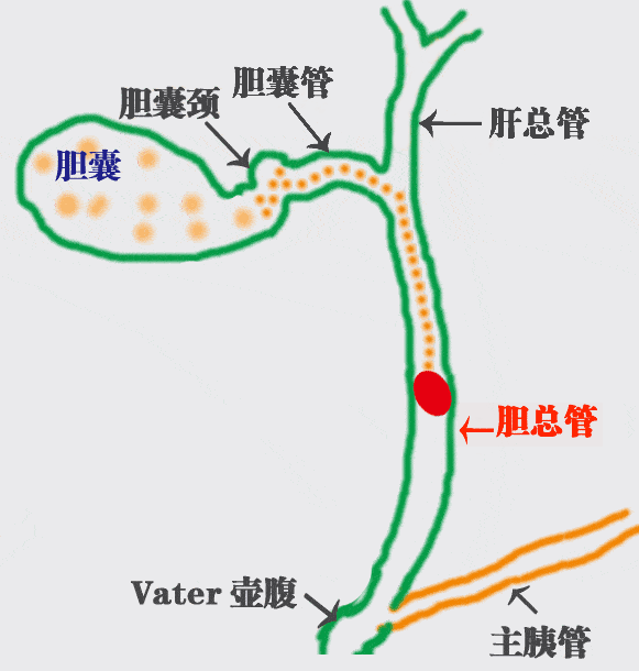 解惑|胆囊结石患者最常问的6个问题,看完不再纠结(图2) 解惑|胆囊结石患者最常问的6个问题,看完不再纠结(图2)