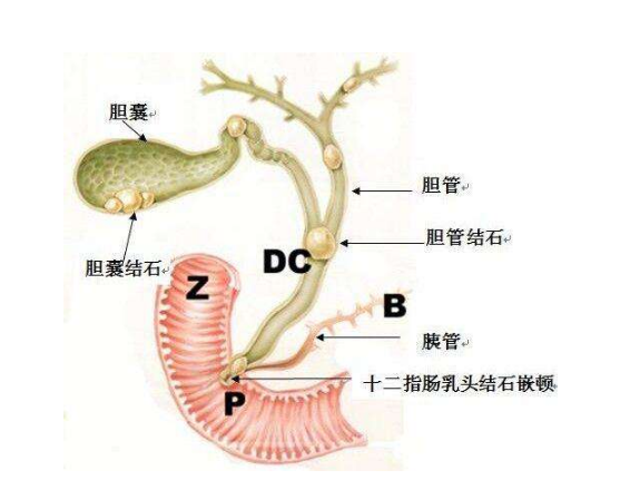 患了胆囊结石,吃药可以化掉吗?来听听肝胆科主任怎么说!(图2) 患了胆囊结石,吃药可以化掉吗?来听听肝胆科主任怎么说!(图2)