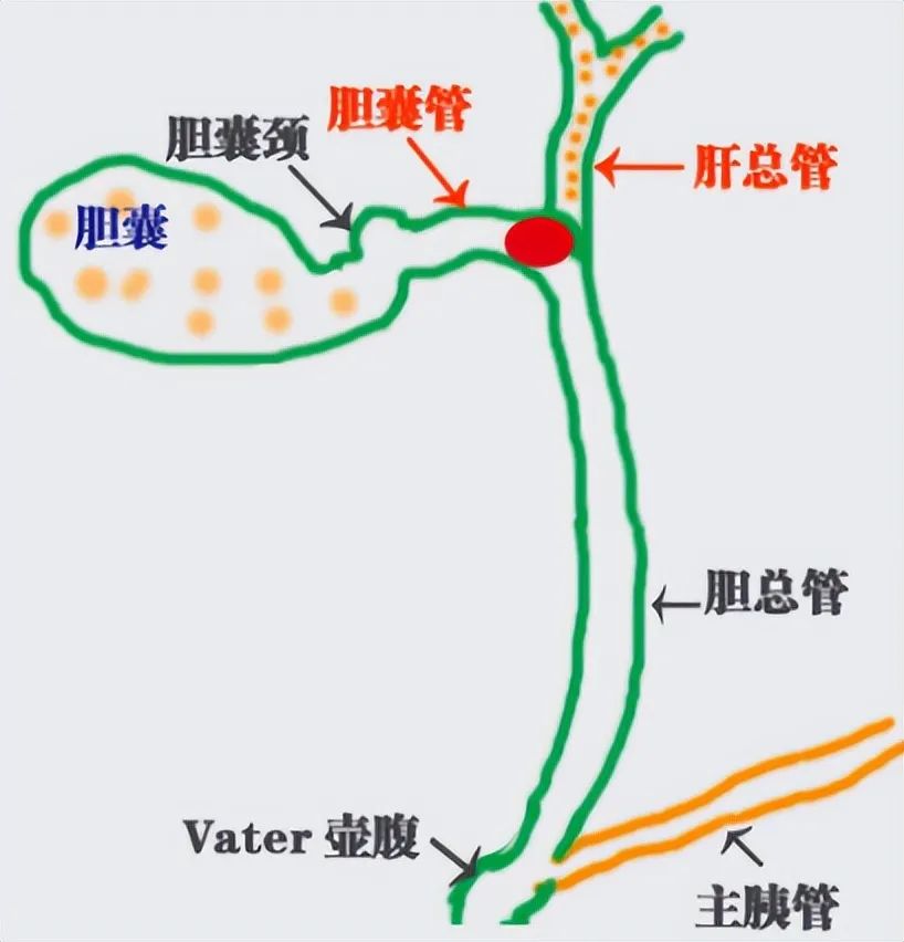患了胆囊结石,吃药可以化掉吗?来听听肝胆科主任怎么说!(图4) 患了胆囊结石,吃药可以化掉吗?来听听肝胆科主任怎么说!(图4)