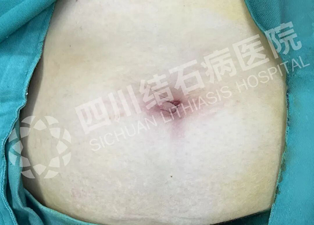 胆好壮壮，人超棒棒：“隐痕保胆”术后，退休教师赠童趣锦旗(图4)