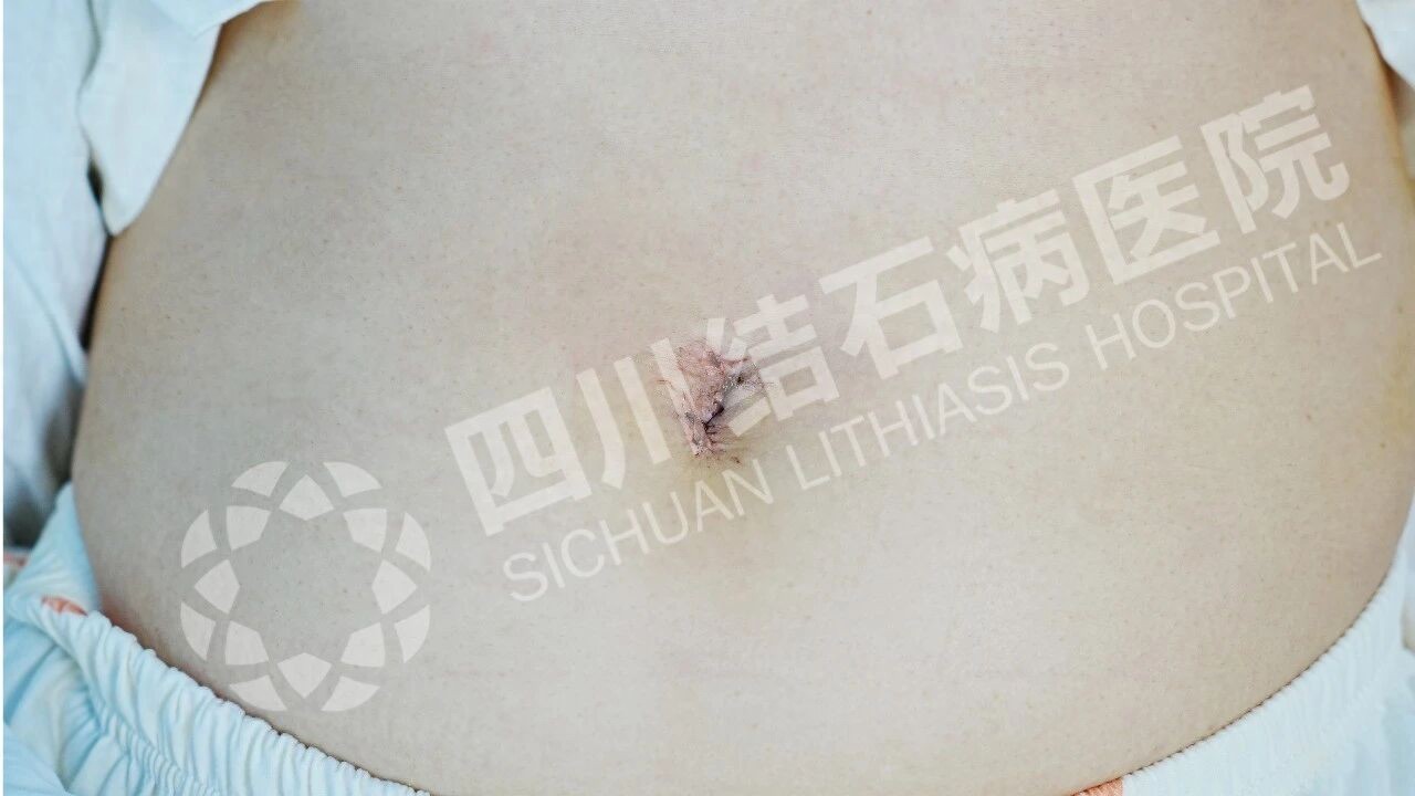 @胆结石患者:决定切胆前,要先了解这些术后风险再决定!(图3) @胆结石患者:决定切胆前,要先了解这些术后风险再决定!(图3)