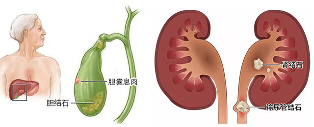 这些症状出现,你有可能患上结石病了,赶紧来自查!【四川结石病医院】(图1) 这些症状出现,你有可能患上结石病了,赶紧来自查!【四川结石病医院】(图1)