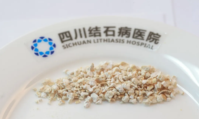 体检查出肾结石,别慌!先搞懂这3件事,少走弯路不遭罪【四川结石病医院】(图2) 体检查出肾结石,别慌!先搞懂这3件事,少走弯路不遭罪【四川结石病医院】(图2)