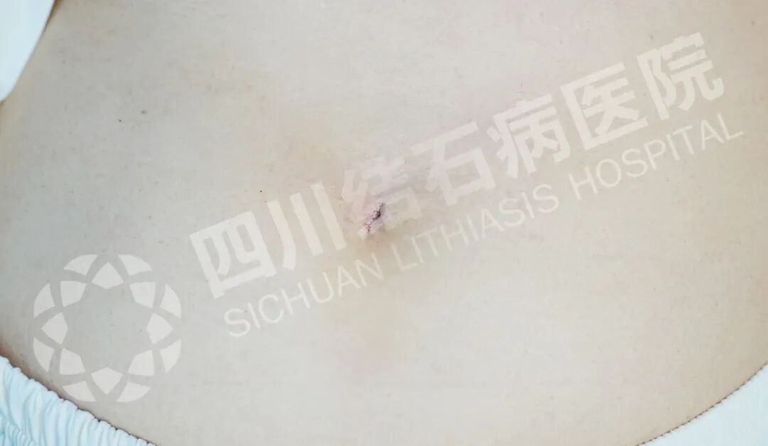 这项“疤痕隐形”手术，让她直呼太先进！【四川结石病医院】(图1)