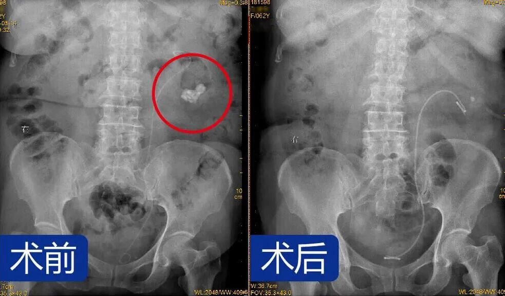 六年“无痛”结石拖成氮质血症！四川结石病医院医生：“再拖就是尿毒症”(图1)