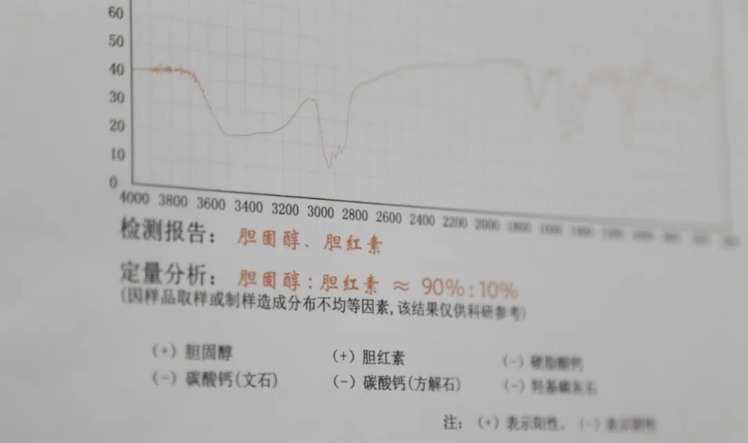 胆囊藏近7公分大结石，四川结石病医院医生：都是吃出来的(图2)