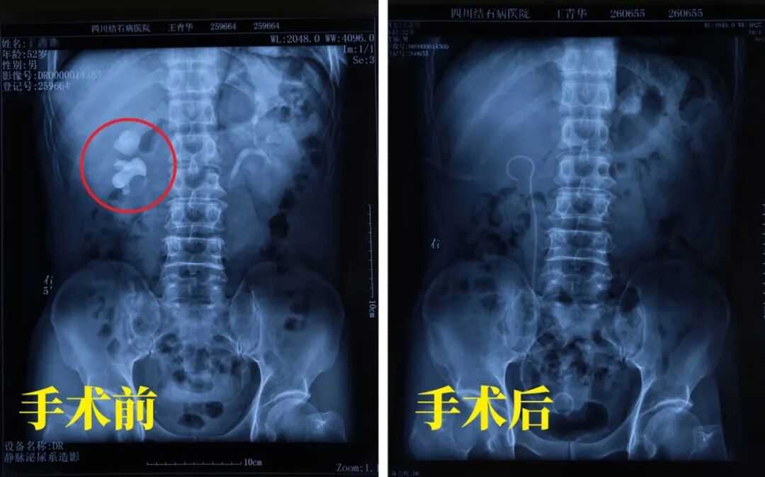 四次治疗没能“搞定”的结石，四川结石病医院一次手术终结(图1)