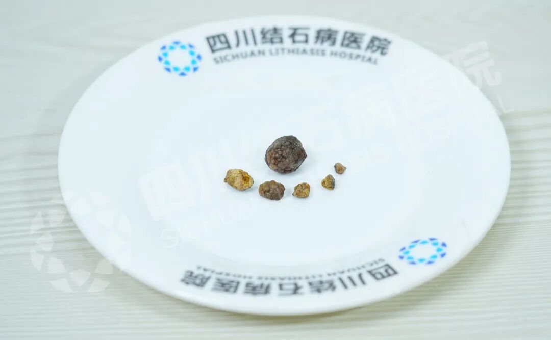 跨越千里的信任：甘肃30岁小伙的“保胆”之路【四川保胆取石医院】(图1)