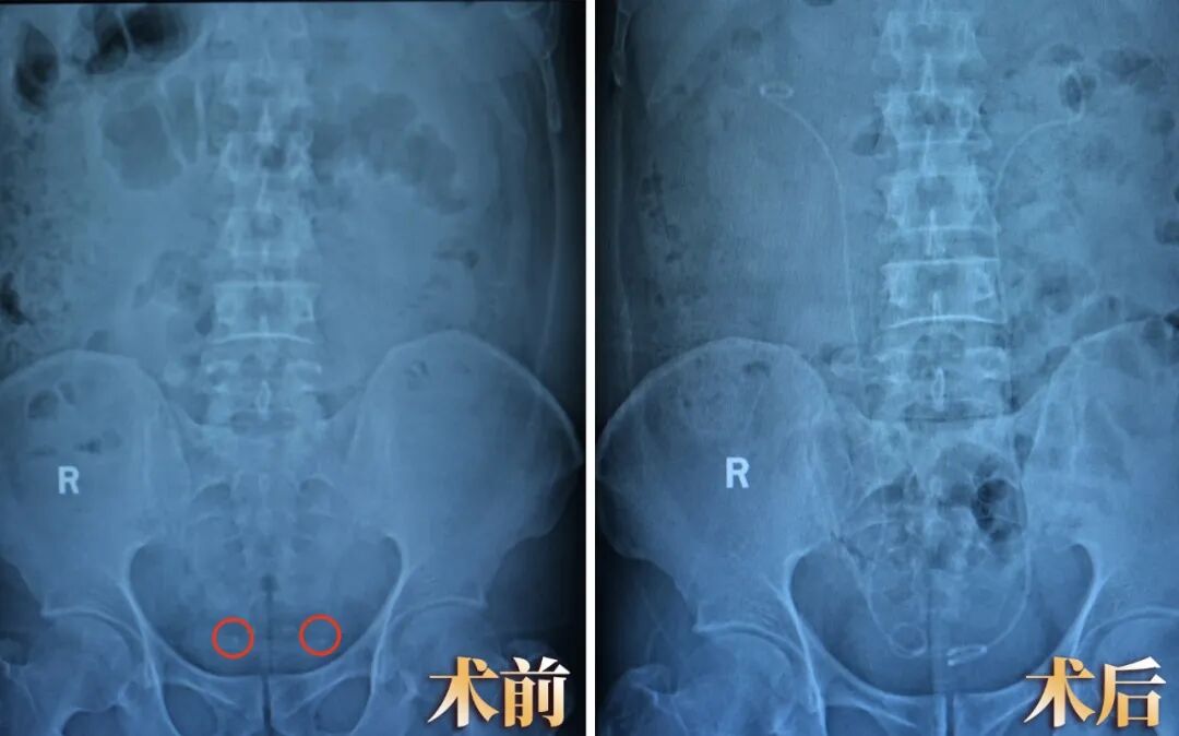 三次托付，是什么让他如此信赖四川结石病医院？(图1)