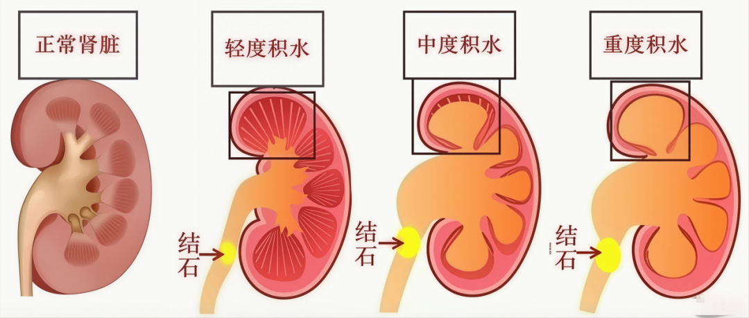 ICU抢救10天！温岚的遭遇敲响警钟：肾结石要早治【四川肾结石医院】(图2)