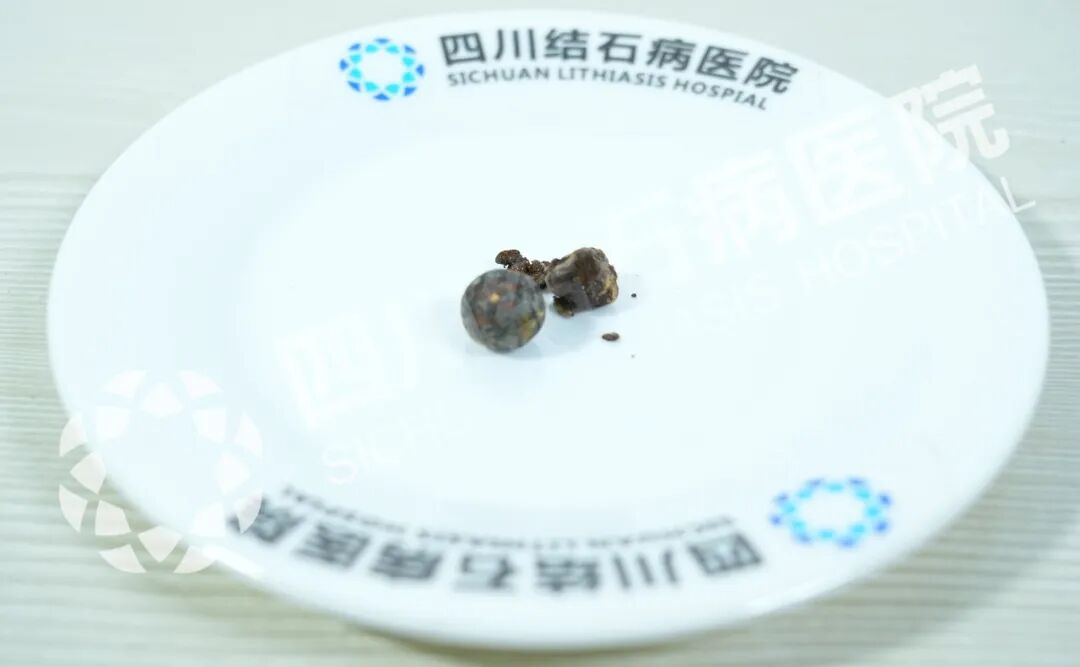 53岁男子闯关高难度罕见综合征！四川结石病医院微创技术再立新功(图1)