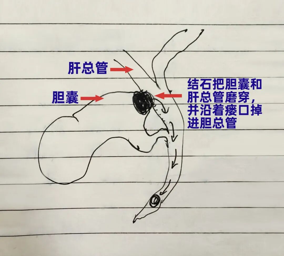 53岁男子闯关高难度罕见综合征！四川结石病医院微创技术再立新功(图2)