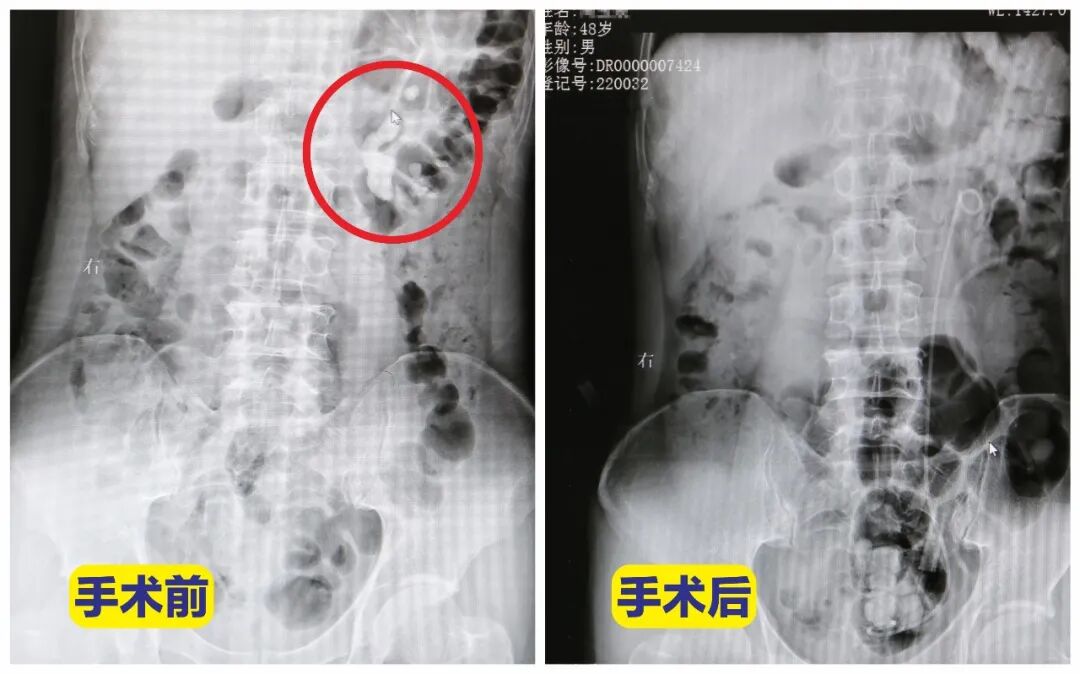 仅三个月！结石梗阻到肾功能重度受损【四川肾结石医院】(图1)