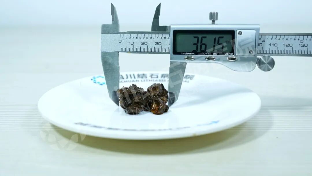 保胆取出3.6公分结石，他说：“冲着四川结石病医院何主任技术来的！”(图1)