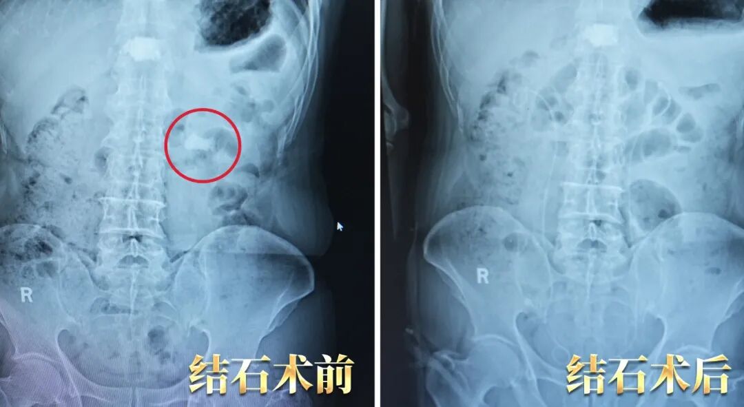 山东千里求医：一台手术，让前列腺增生和肾结石“团灭”(图2)