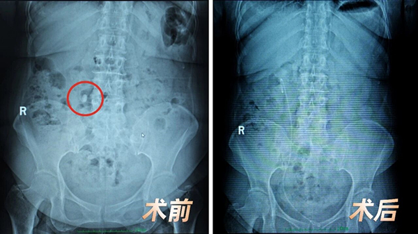 五次托付，一位“结石体质”患者的坚定选择【四川结石病医院】(图1)