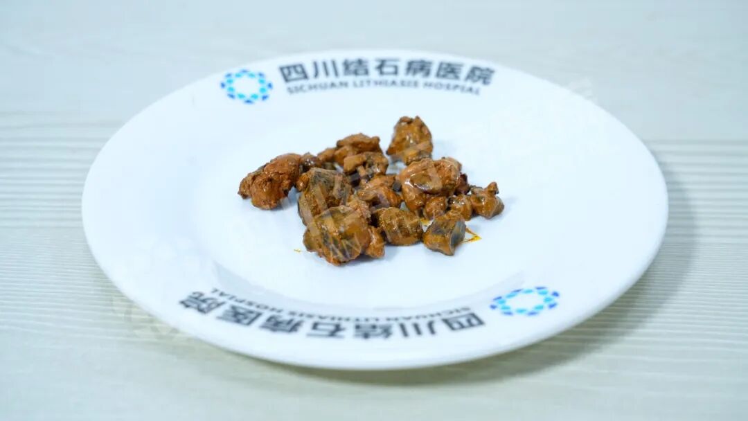 切了胆40年，没想到“结石”还能找上门！四川结石病医院(图1)