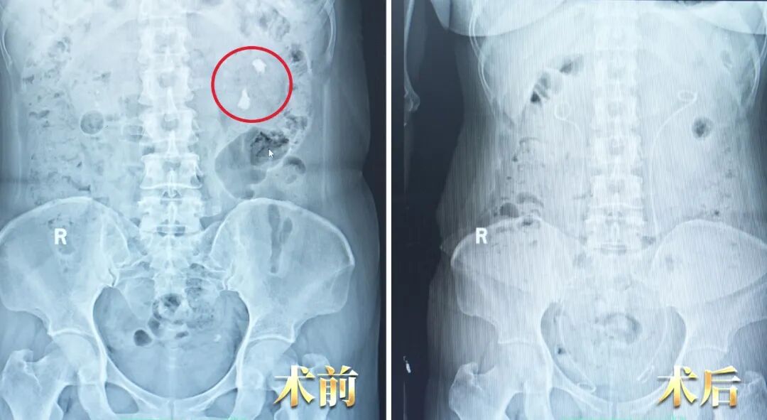 崇州女子肾脏积脓！只因结石一个“拖”字【四川肾结石医院】(图1)