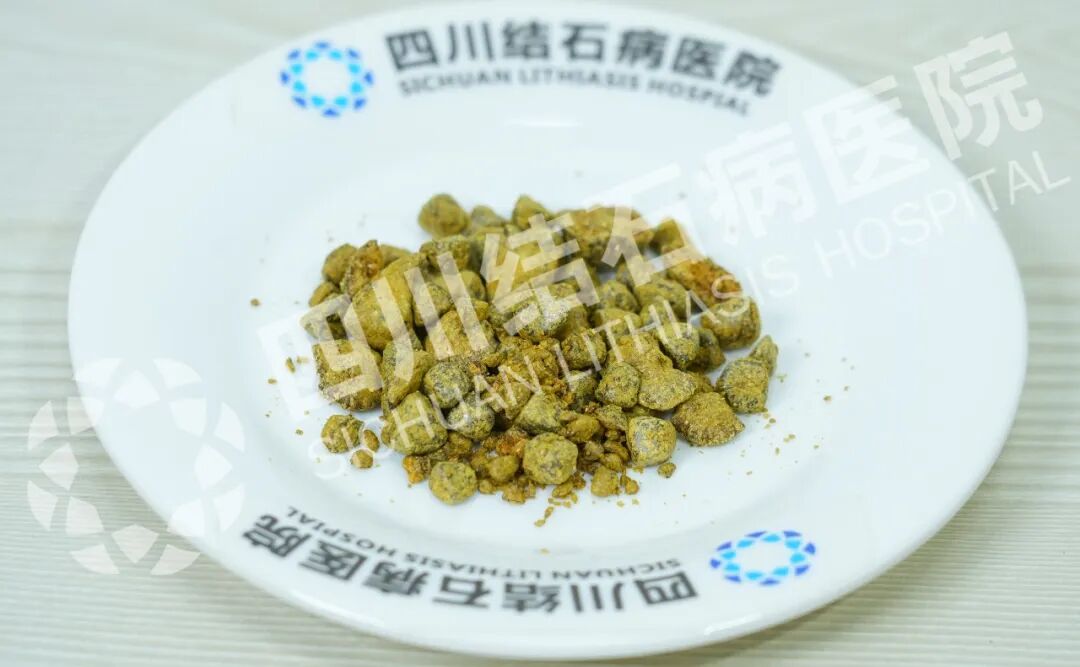 又一大盘结石，成功保胆！四川保胆取石医院(图1)