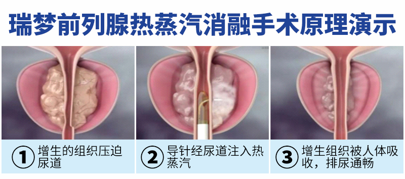【感恩父亲 “腺”在行动】瑞梦3分钟，让“前腺”烦恼“蒸”的消失(图3)