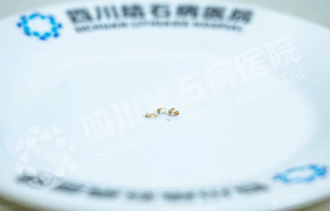 观战世界杯遭遇突发腰痛！当心，这是结石发出的警报【四川24小时碎石医院】(图1)